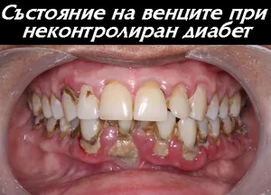 Измерване на кръвна захар при диабет