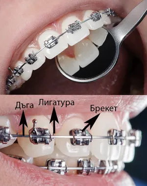 Метални брекети