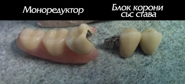 Ставата на моноредуктора — връзката между блок короните и микропротезата