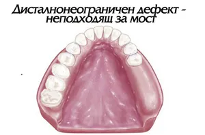 Моноредуктор — ставна микропротеза за липсващи задни зъби
