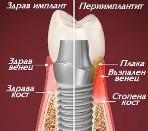 Периимплантит — инфектиране и стопяване на костта около импланта