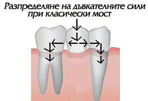 Схема на класически зъбен мост с два опорни зъба