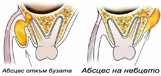 Схема на видовете абсцес — ендодонтски и пародонтален