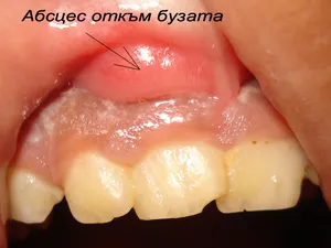 Оток на венеца при ендодонтски абсцес