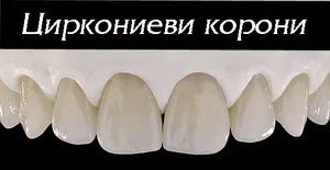 Циркониеви корони