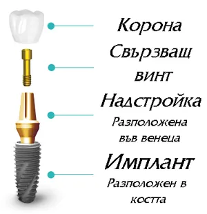 Двучастов имплант — имплант, надстройка и винт