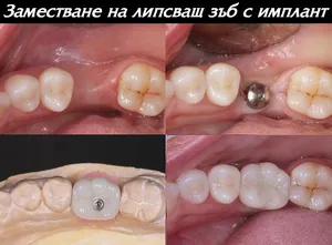 Единичен зъбен имплант