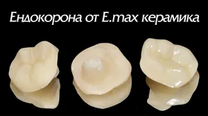 Ендокорона на преден зъб