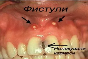 Фистула върху венеца в проекцията на корена на болния зъб