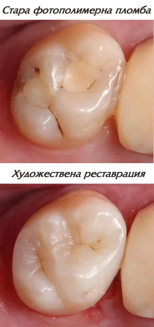 Художествена реставрация на зъб
