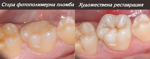 Художествена реставрация, изработена с кофердам