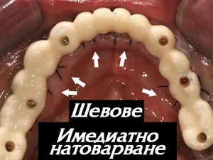 Неснемаем мост, фиксиран винтово върху 6 или 8 импланта