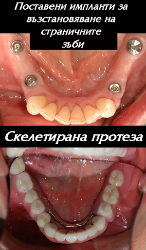 Импланти и протеза при останали само предни зъби