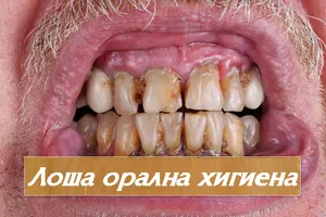 Почистване на зъбите и имплантите