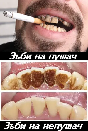 Цигара — тютюнопушенето е сериозно противопоказание за импланти