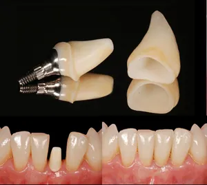 Корона върху имплант с Veneer abutment