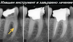 Изваден от коренов канал счупен инструмент