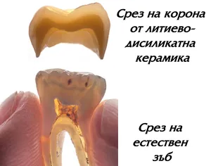 Корона от чиста керамика