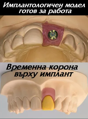 Временна корона върху имплант