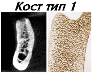 Кост от тип 1 — най-твърдата и плътна, като дъбово дърво