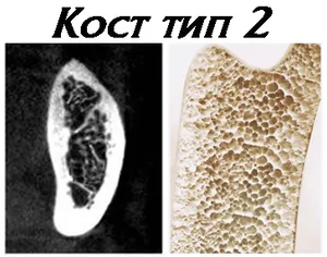 Кост от тип 2 — по твърдост като борова дървесина