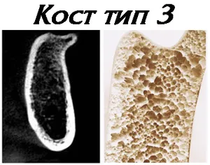 Кост от тип 3 — по твърдост като корк