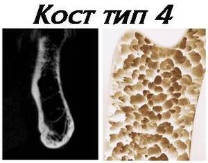 Кост от тип 4 — най-меката, като стиропор