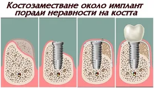 Локално костозаместване около импланта, покрито с мембрана