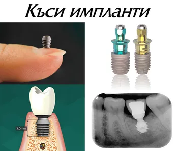 Къси импланти за малка височина на костта