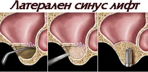 Латерален синуслифт — изкуствена кост в синуса
