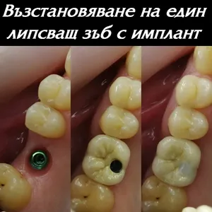 Единичен имплант на мястото на един липсващ зъб