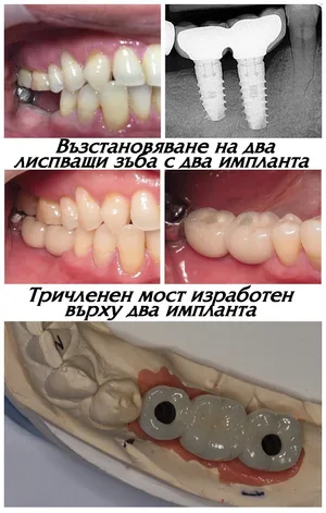 Два импланта с две корони на мястото на два липсващи зъба