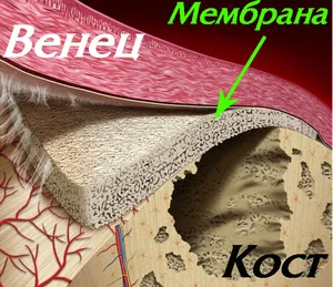Мембрани за костозаместване