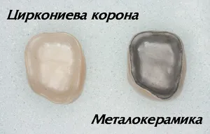 Металокерамични и циркониеви корони