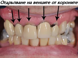 Мостове върху живи зъби с отдръпнал се венец