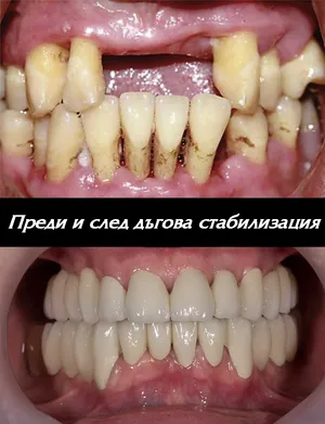 Мостова конструкция за стабилизиране на разклатени зъби