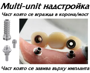 Мулти-юнит надстройки за импланти