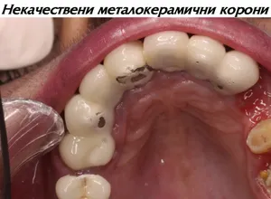 Некачествена металокерамична корона