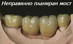 Неправилно планиран мост с недостатъчно носещи зъби
