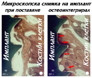 Имплант в кост — третият етап на остеоинтеграцията, узряване на костта