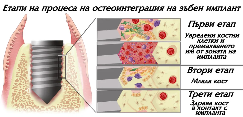 Схема на остеоинтеграцията — костта нараства около повърхността на импланта