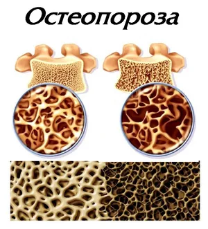 Остеопороза — по-чуплива костна структура