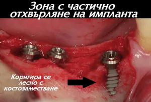 Имплант, който не е интегриран в костта