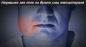 Оток на бузата в първите дни след поставяне на имплант