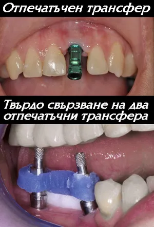 Отпечатък от имплант с отпечатъчен трансфер