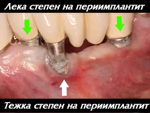 Възпаление на венеца около имплантната корона от зъбна плака