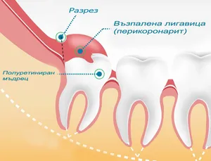 Перикоронарит – възпален венец над полупробил долен мъдрец