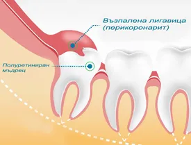 Полуретиниран мъдрец с възпален венец – перикоронарит