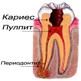 Илюстрация към лечението на периодонтит