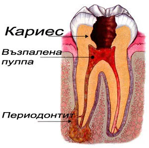 Периодонтит – възпаление около върха на зъбния корен
